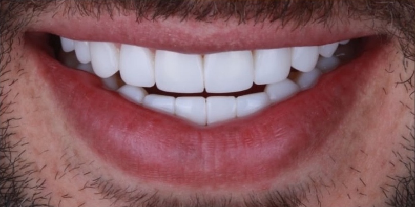 Depois do tratamento com facetas em resina
