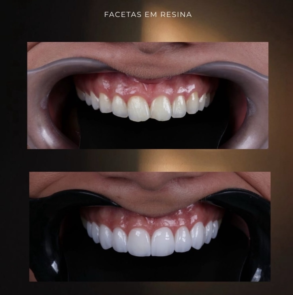Transformação estética com facetas de resina na clínica Dra. Lorena Carvalho